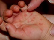 СЭРЭМЖЛҮҮЛЭГ: Энтеровирусын халдвараас сэргийлье Enterovirus