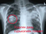 Сүрьеэ төгс эдгэрдэг өвчин Сүрьеэ