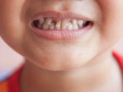 Шүд цоорох өвчний тархалт ихсэж байна !!!