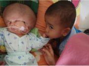 250 мянгад нэг тохиолдох ХОЁР НҮҮР-тэй хүүхэд төржээ Indonesia_hoer_nuurtei_huuheed