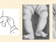 Хүүхдийн “түнхний дутуу хөгжлийн эрт үеийн оношилгоо, эмчилгээ” сэдвээр хэлэлцлээ huuhdiin-tunh