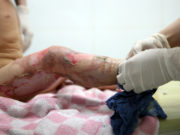 АНХААР: Халуун тогоонд түлэгдэх ГЭМТЭЛ зонхилж байна haluun-togoond-tulegdeh