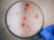 СҮХБААТАР: Тэмбүү өвчний 315 тохиолдол бүртгэгдлээ! tembuu-owchin