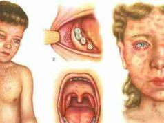 “Оюутолгой” компаниас улаанбурхан өвчин илэрчээ ulaanburhan